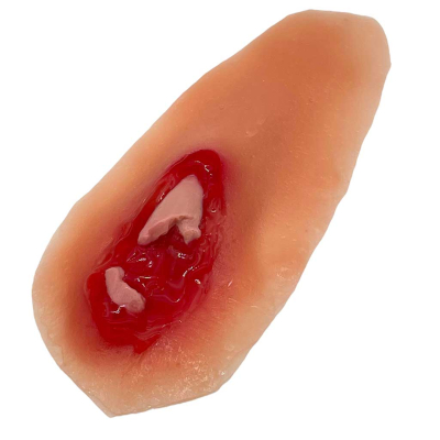 Prothèse fracture ouverte du poignet