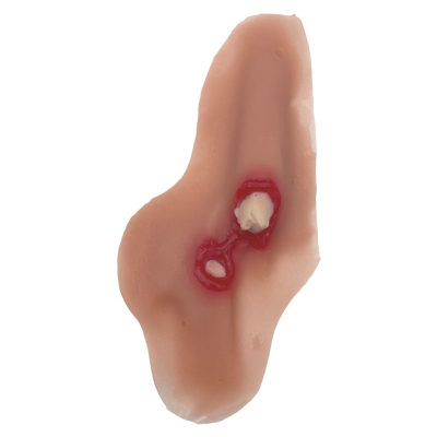 Prothèse fracture ouverte du tibia