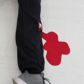 Fracture filet ouverte du tibia