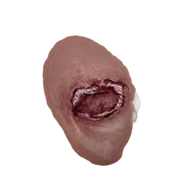 Plaie filet à l’œil