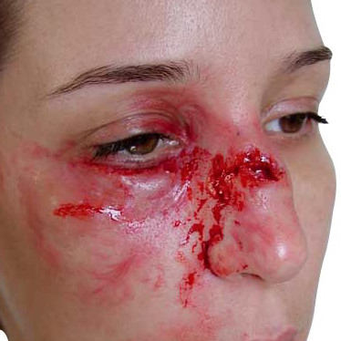Prothèse fracture du nez