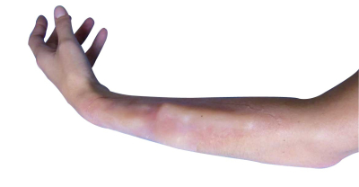 Prothèse fracture intérieure bras/avant-bras/clavicule