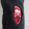 Fracture filet ouverte du tibia