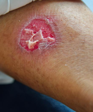 brûlure accident