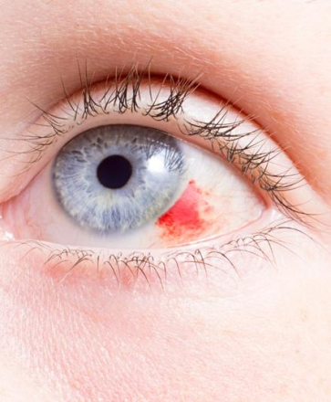 lesion oculaire