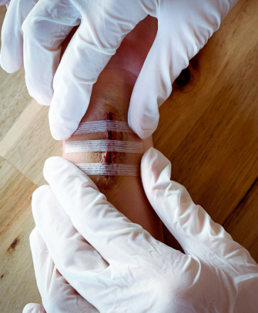 poser une suture adhésive