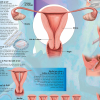 La contraception